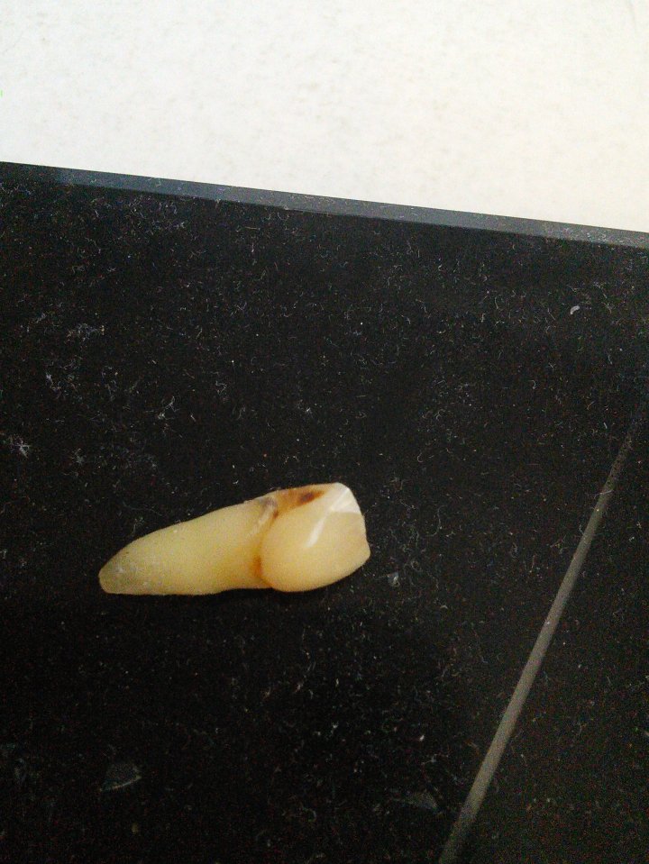 The idiotic burglar left his tooth behind at the scene after biting Ronald
