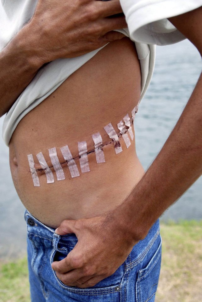 A scar after an operation to remove a kidney