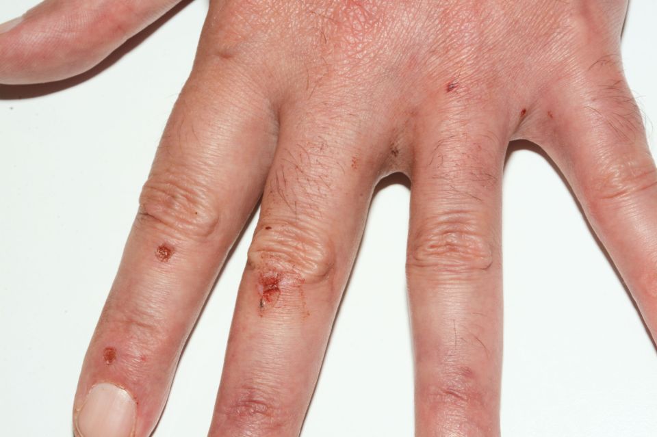 An injury to the hand of Thomas Mair which was shown to jury at the Old Bailey today 