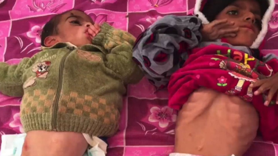 Horrific pictures have recently emerged which show emaciated children arriving at refugee camps after fleeing the city