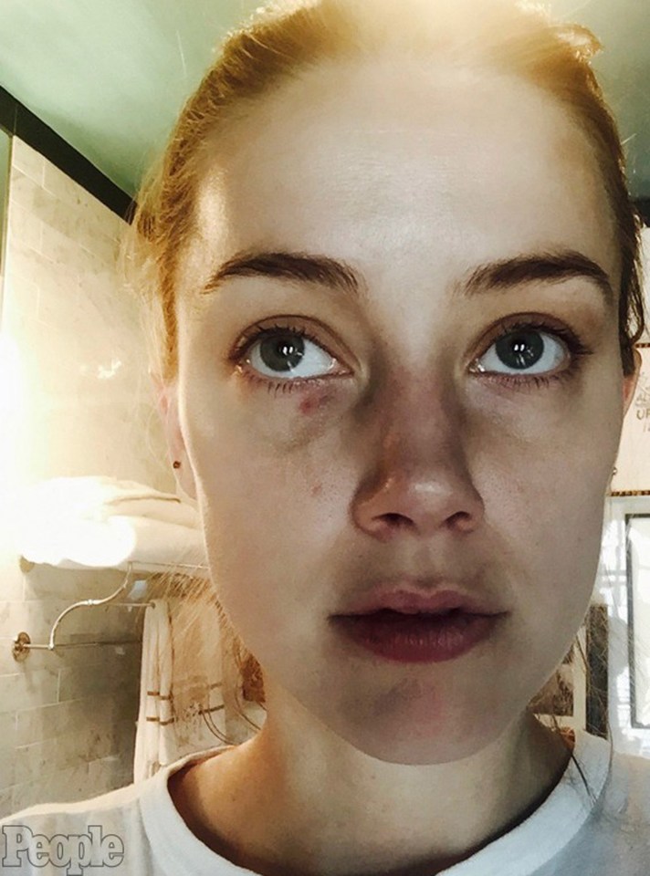 Amber Heard shows the bruises on her face, allegedly caused by Depp