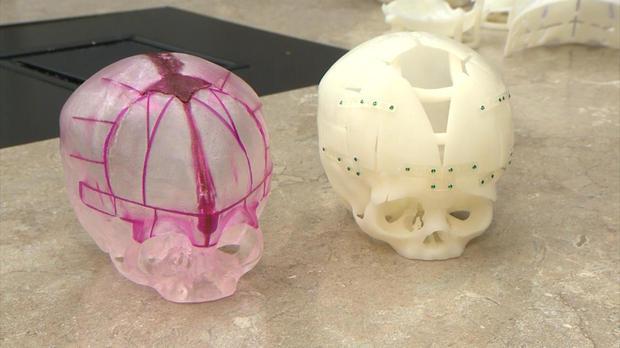  3D-printed models of Vincent’s head allowed doctors to explore the “before and after” from all angles