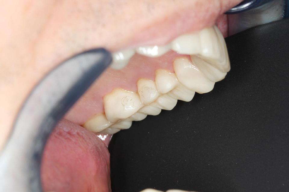 The painstaking work added significantly to his dentist fee 