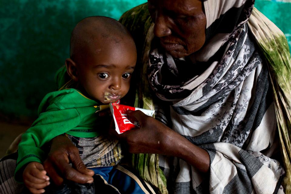 A malnourished child is given a high-calorie peanut paste in Somalia 