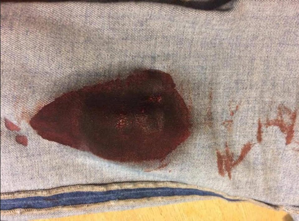 Lizzies blood-soaked jeans after the bomb attack last night