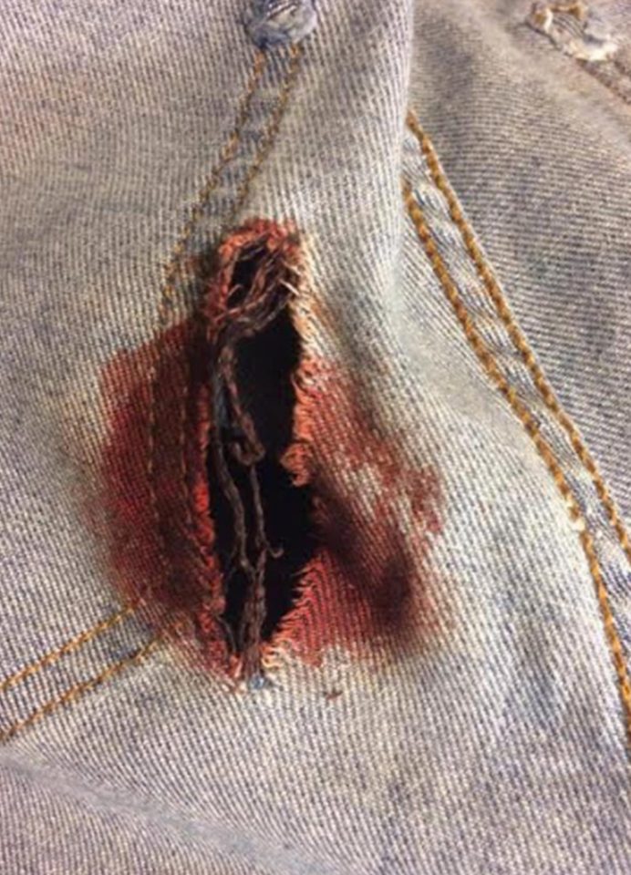 Pieces of shrapnel from the suicide bomb tore through Lizzies jeans into her flesh