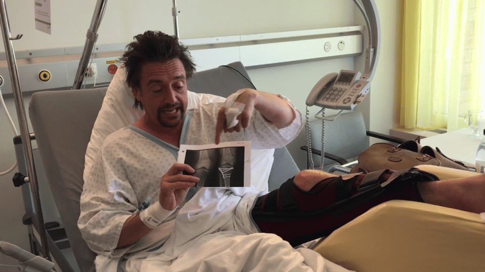  Hammond held up an X-ray show how doctors plan to fix his shattered knee