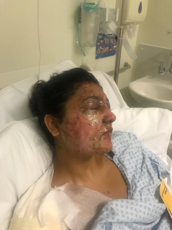 The student has had skin grafts after suffering burns to her face and body