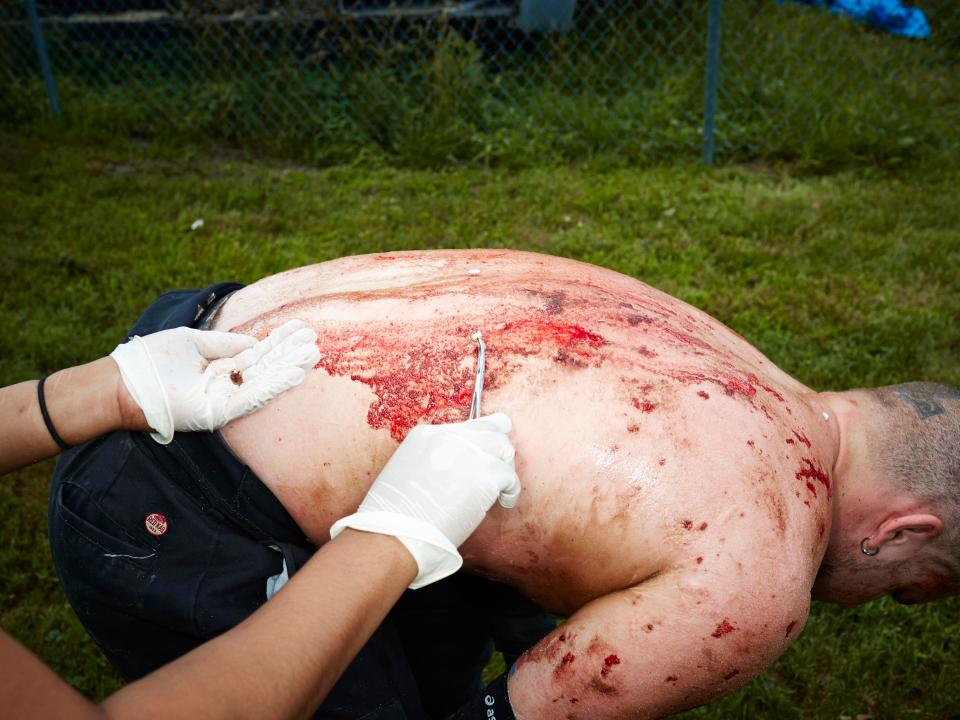  Wrestler Danny Havoc has glass and thumbtacks removed from his back by an off-duty nurse