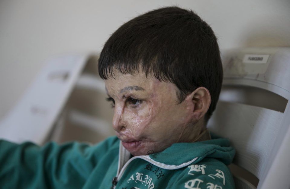 Hassan al Hussein, seven, was injured by an Assad regime barrel bomb