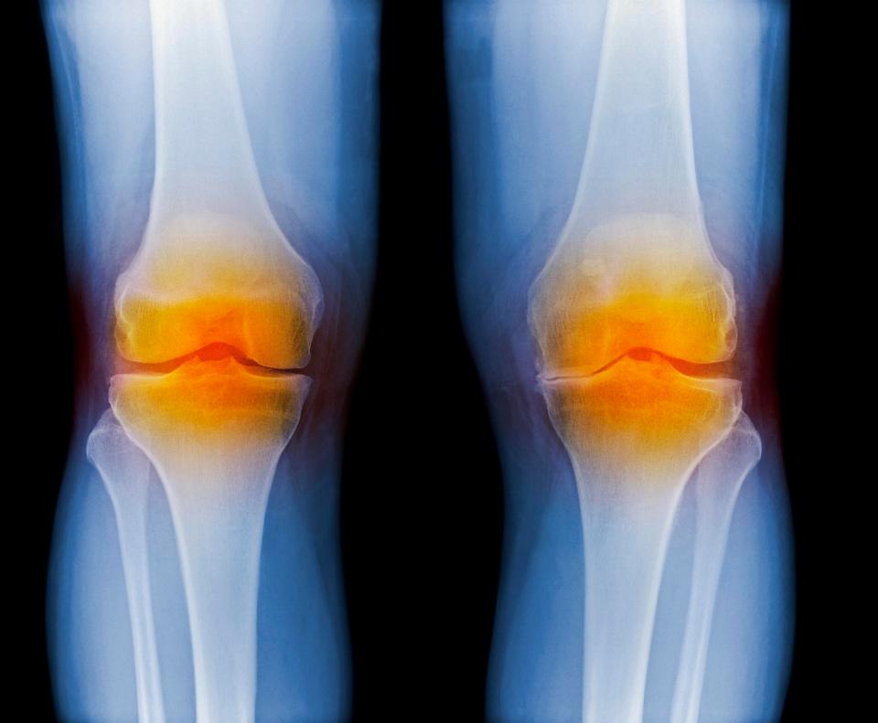 Arthritis can also be more painful during the colder months but it is not clear why