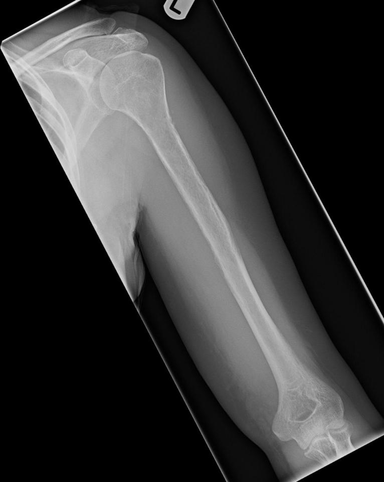 The woman first went to hospital complaining of pain in her left arm