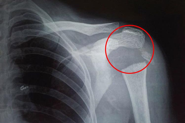 X-rays revealed the woman's humeral head, the ball of bone that joins the shoulder, had vanished