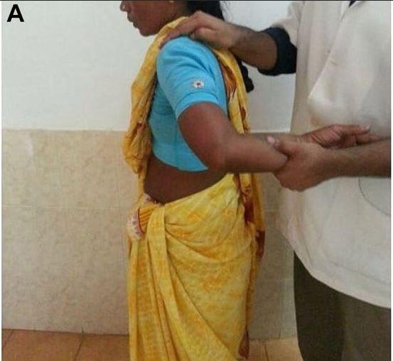 The woman sought medical help after three months of gradual pain in her shoulder
