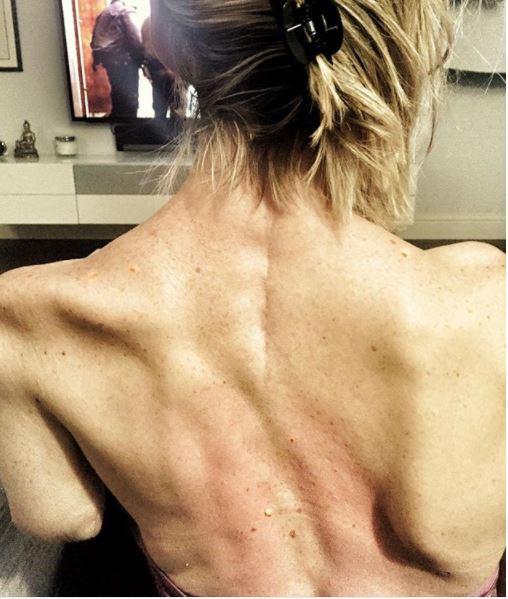  Injuries to her back include a twisted spine and dislocated shoulder