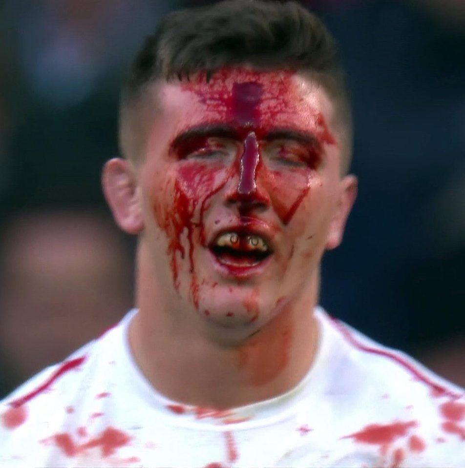 England flanker Tom Curry split his forehead open in an accidental clash with Damian Penaud's chin 