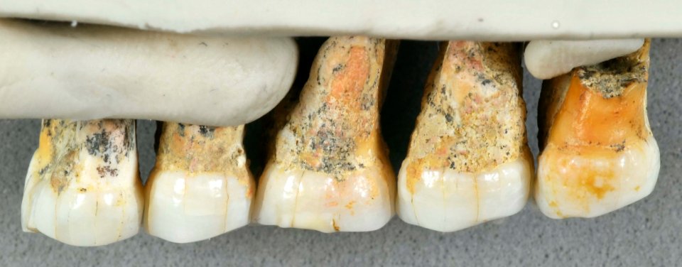  The teeth of Homo luzonensis are consistent with the remains being assigned to a new species