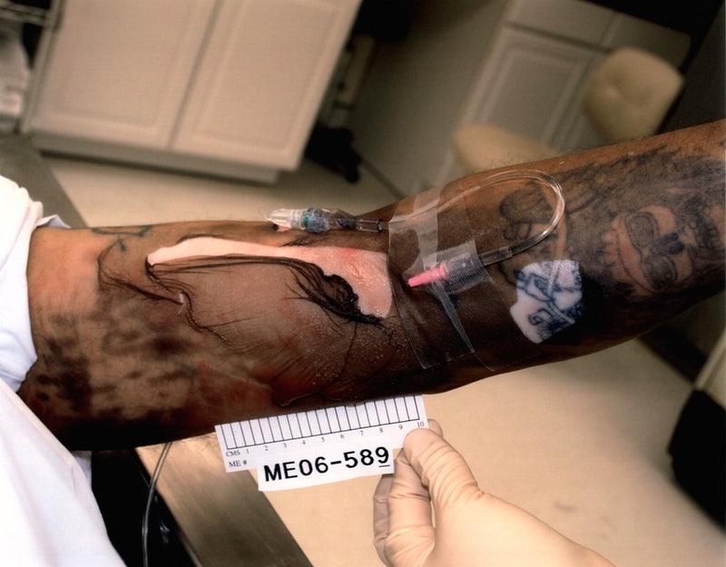 Diaz's left arm had an 11-by-7 inch chemical burn from the lethal drug