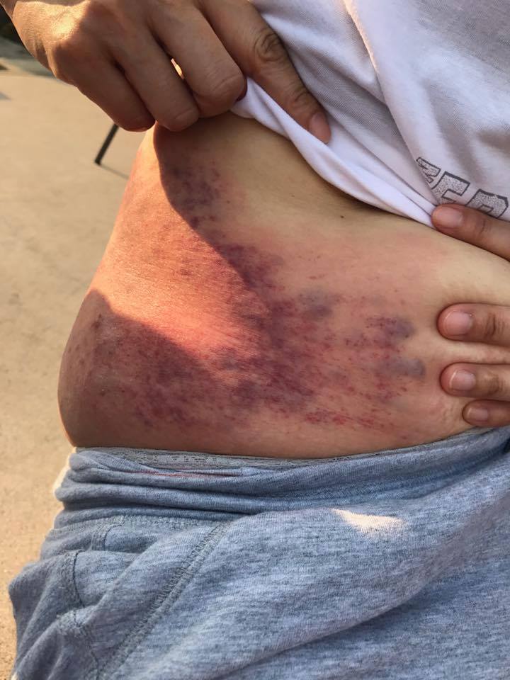 Bruises