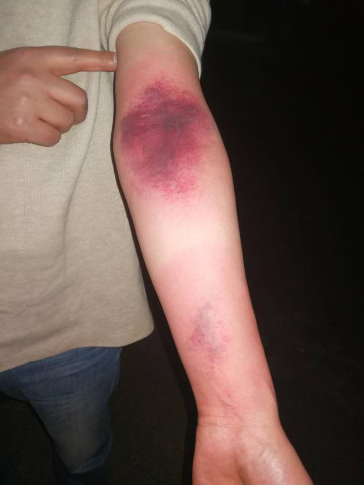 Bruises