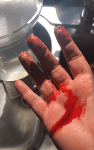  Her hand was left gushing with blood