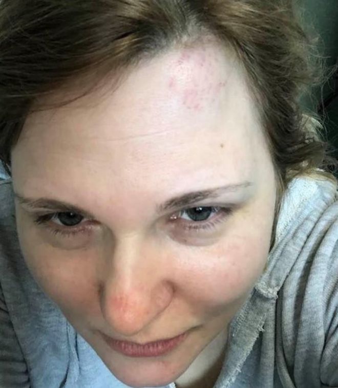  She was beaten by a gang in Grozny earlier this year - she believes it was a reprisal for her work