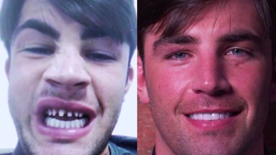 Jack is thrilled with his teeth - but says people should do their research