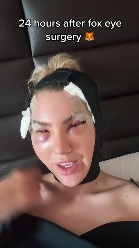 Mollie showed fans what her face looked like 24 hours after her procedure
