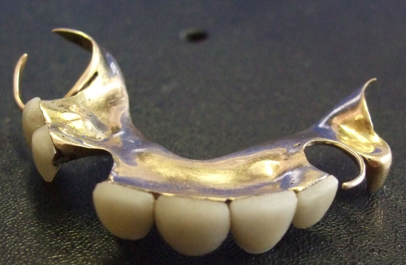 This partial upper gold-mounted set was one of around four designed by the Prime Minister’s dentist