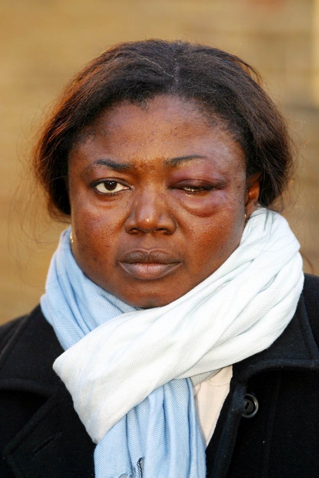 Woman with a black eye.