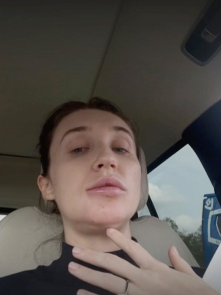 She suffered significant swelling which affected her breathing