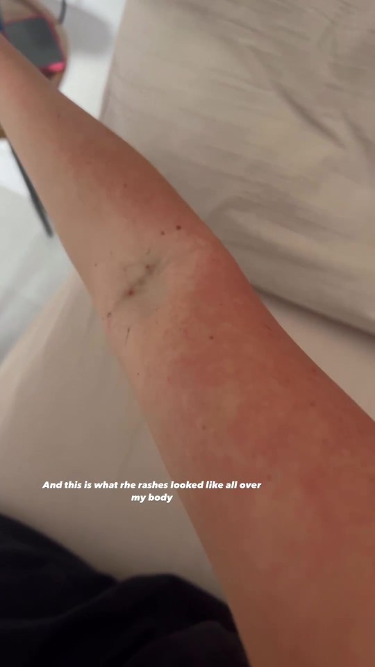 a close up of a person 's arm with the caption " and this is what the rashes looked like all over my body "