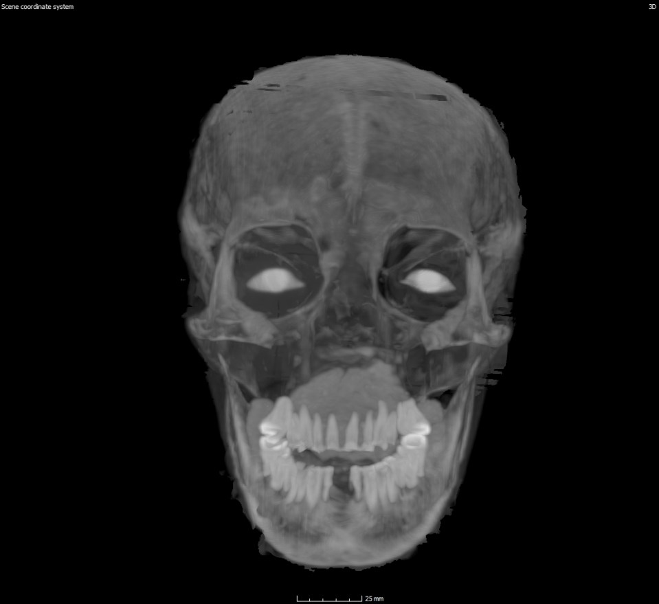 an x-ray of a skull with a score coordinate system of 30