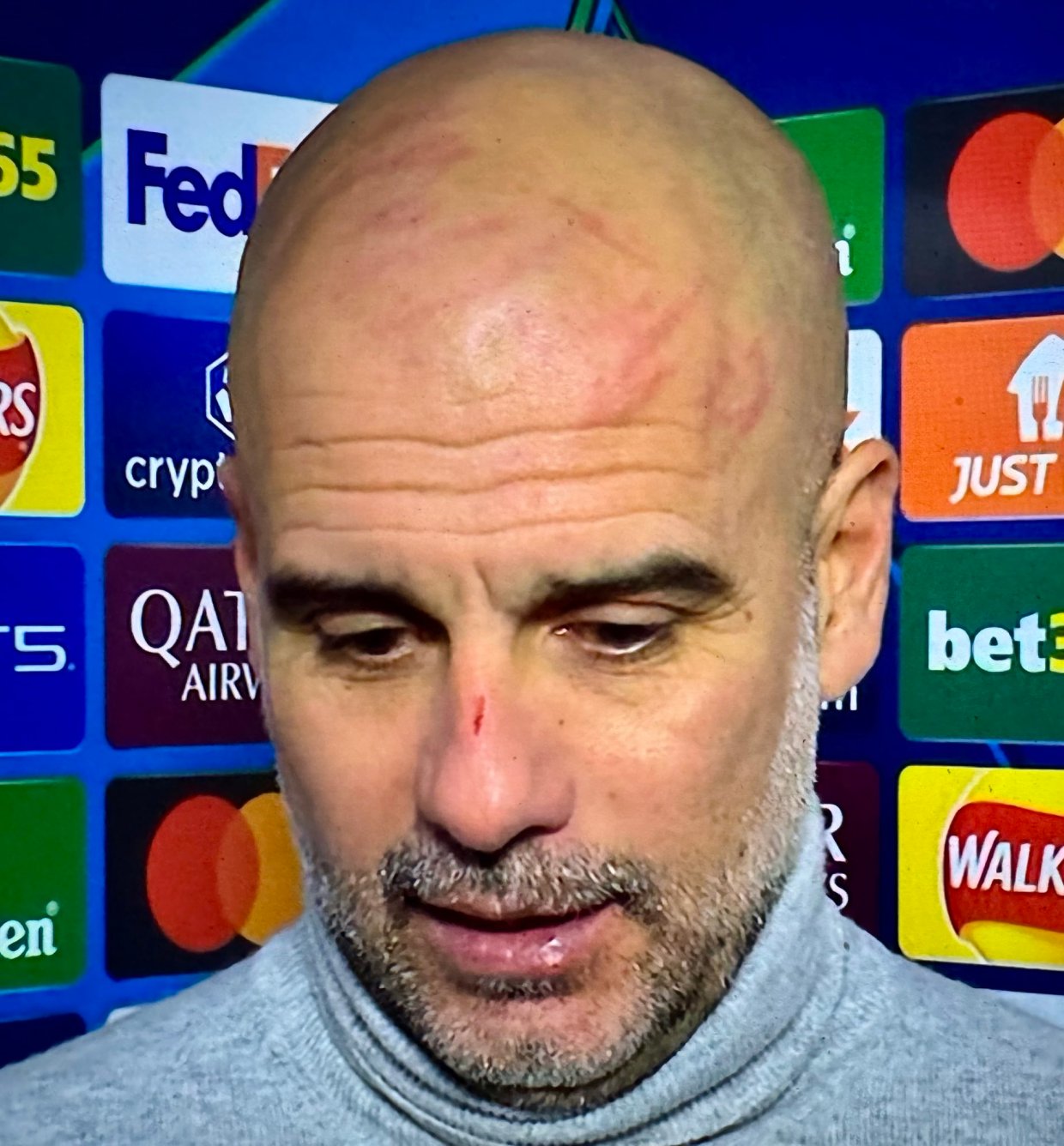 The Spaniard appeared with red scratch marks over his face and head in late November