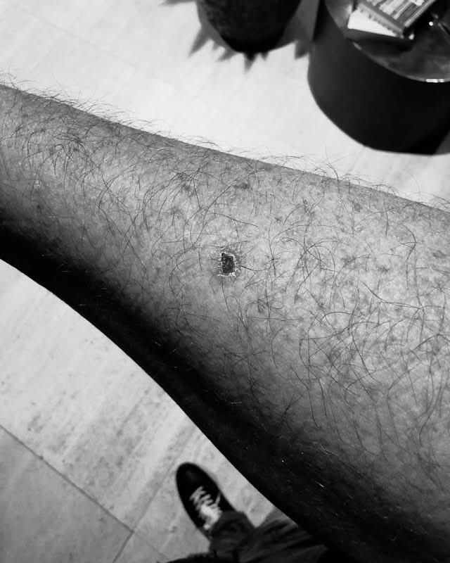 Close-up of a small wound on a hairy arm.