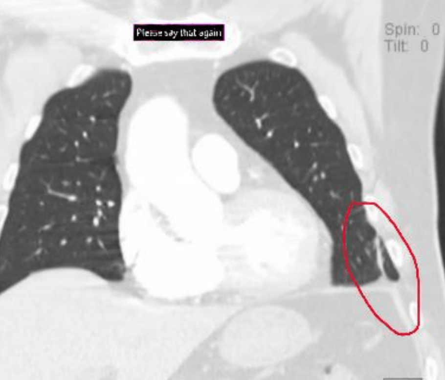 CT scan of the chest showing an abnormality.