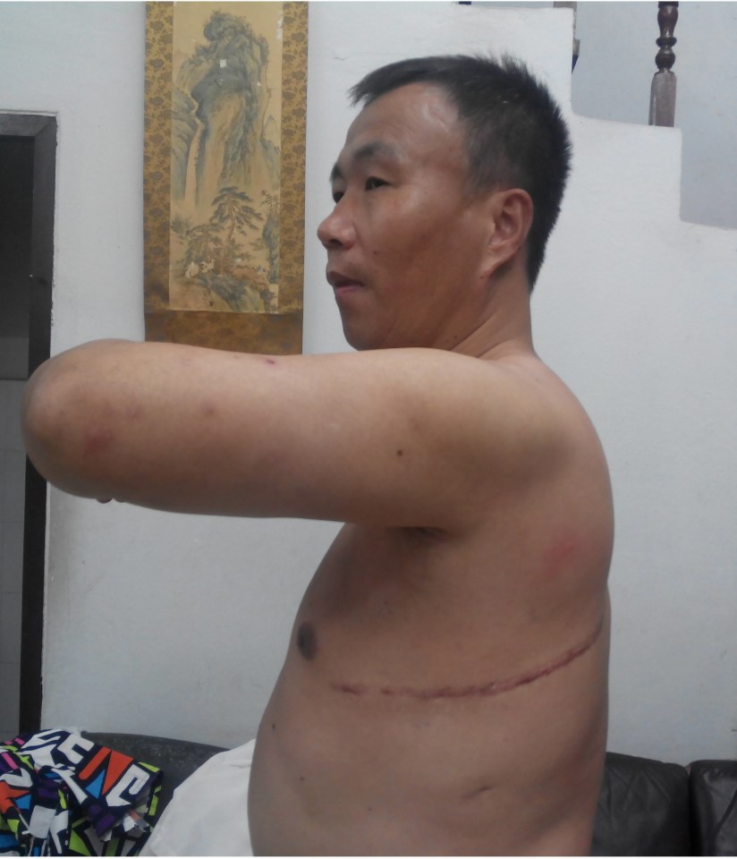 Man with surgical scar on his torso.