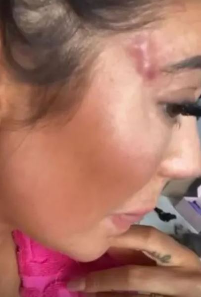 Close-up of a woman's face showing a bruise on her temple.