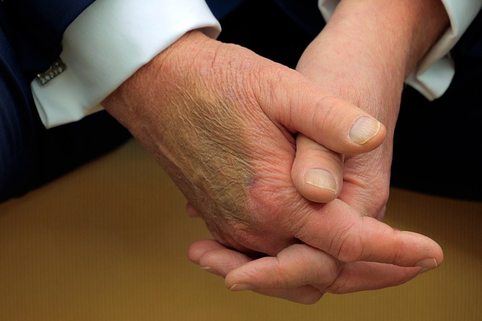 Close-up of hands with makeup covering a bruise.