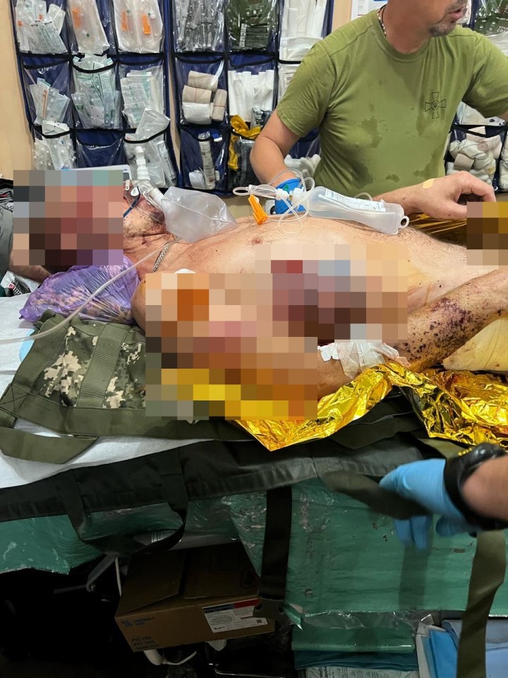 Severely injured man on stretcher receiving medical attention.