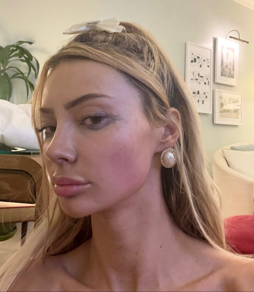 Close-up of Bri Stern showing bruises.