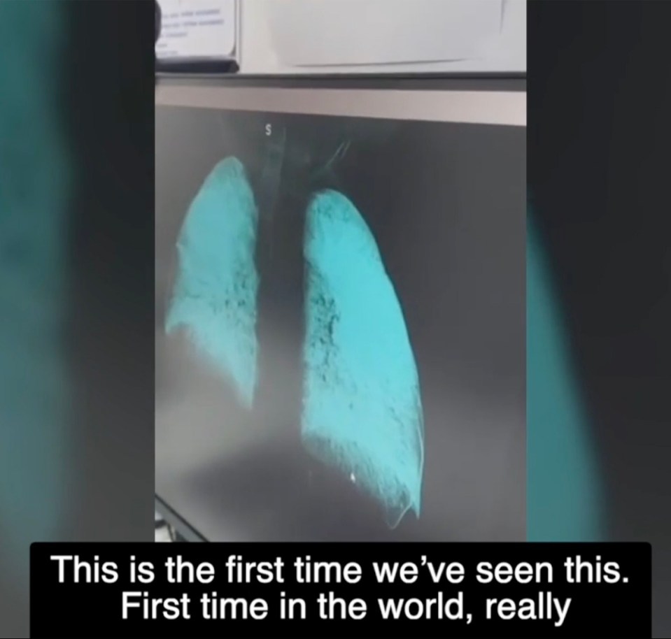 X-ray of lungs showing chemical pneumonitis.
