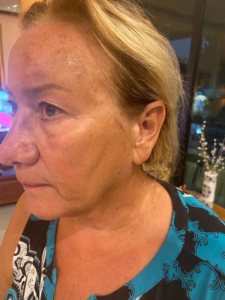 Close-up of a woman's face showing injuries.