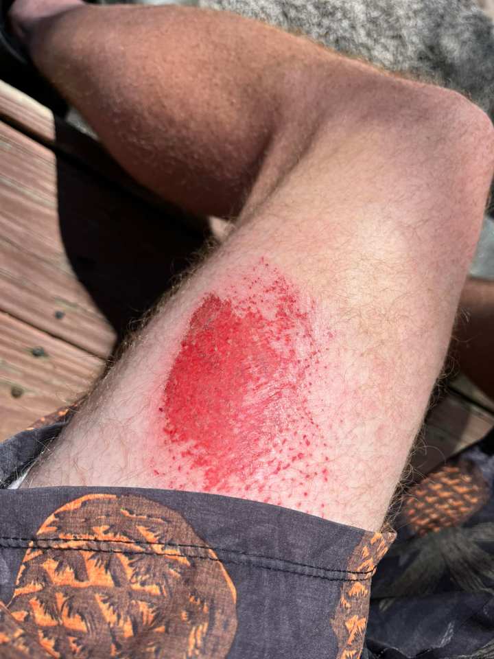 Close-up of a large abrasion on a person's leg.