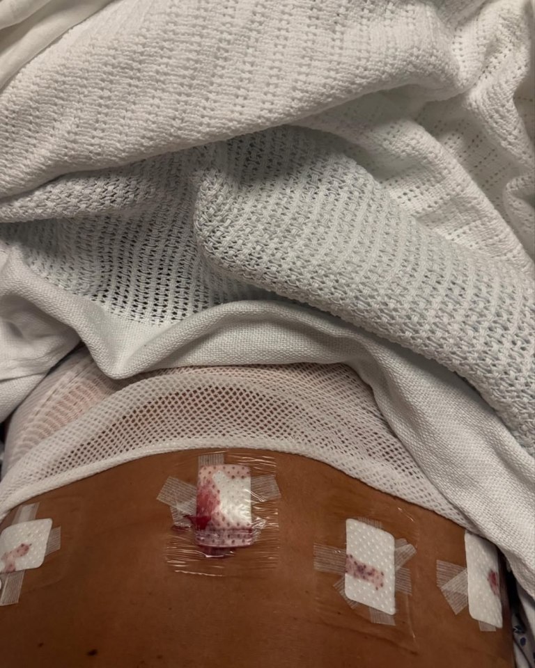 Post-surgical abdominal wound with bandages.