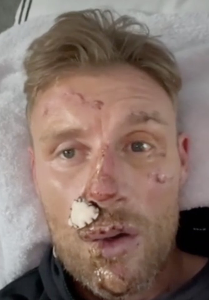 Close-up of Freddie Flintoff with facial injuries.