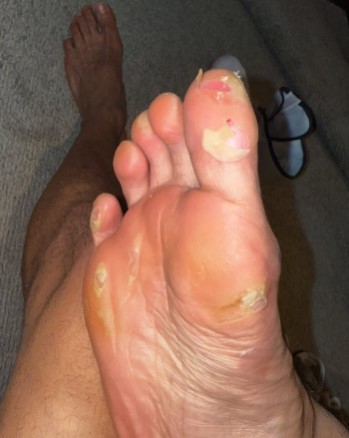 Chris Eubank Jr.'s injured foot with blisters and bandages.