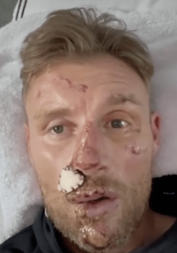 Close-up of Freddie Flintoff with facial injuries.