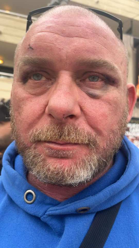 Close-up of a man with facial injuries.