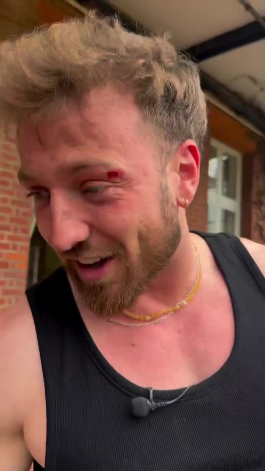 Sam Thompson with a bloody cut above his eye.
